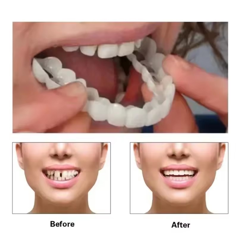 Okładziny na zęby Wybielanie z – Teeth Whitening With Braces recenzja i cena