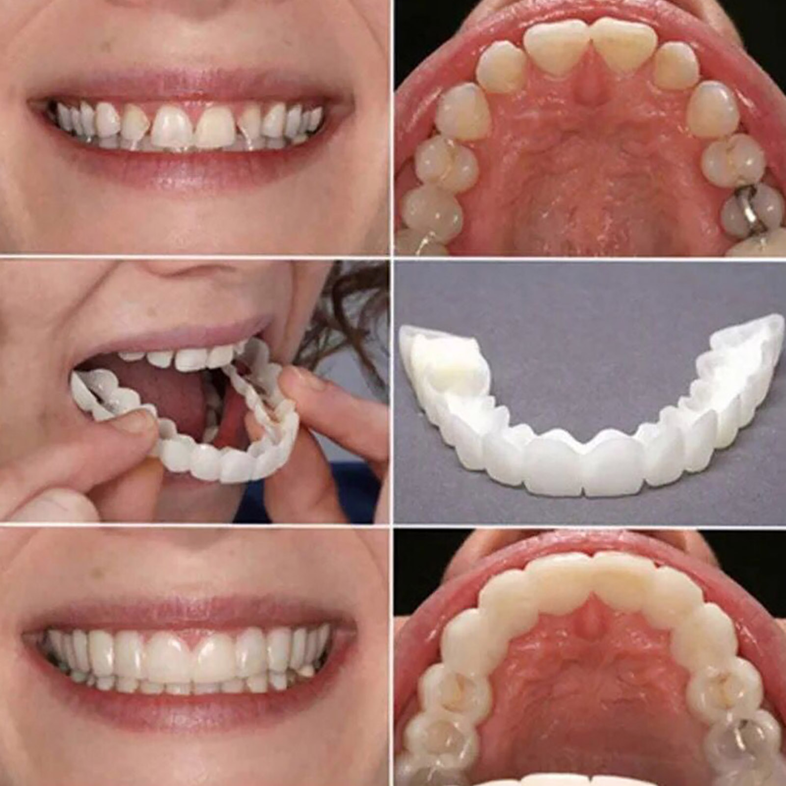 Okładziny na zęby, wybielanie, – Teeth Whitening With Braces recenzja i cena