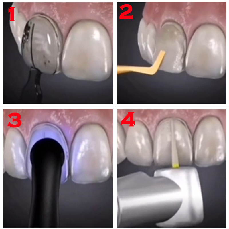 Forma dentystyczna do licówek  – Teeth Whitening Veneers recenzja i cena