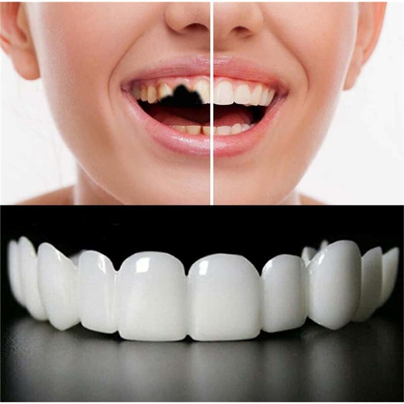 [NOWOŚĆ! ABMK】 2 Pary, Przywró – Teeth Whitening With Braces recenzja i cena